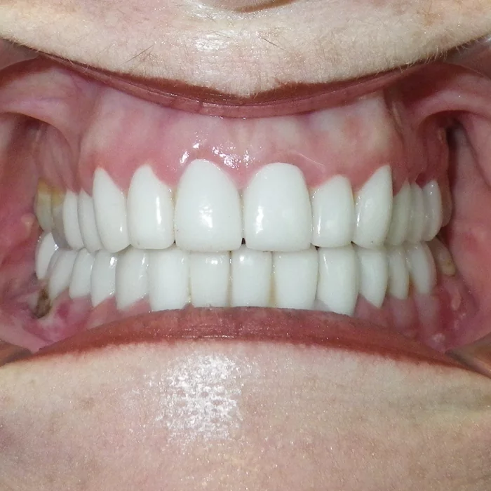 m-4-dental-crowns-dentist-cancun-affordable