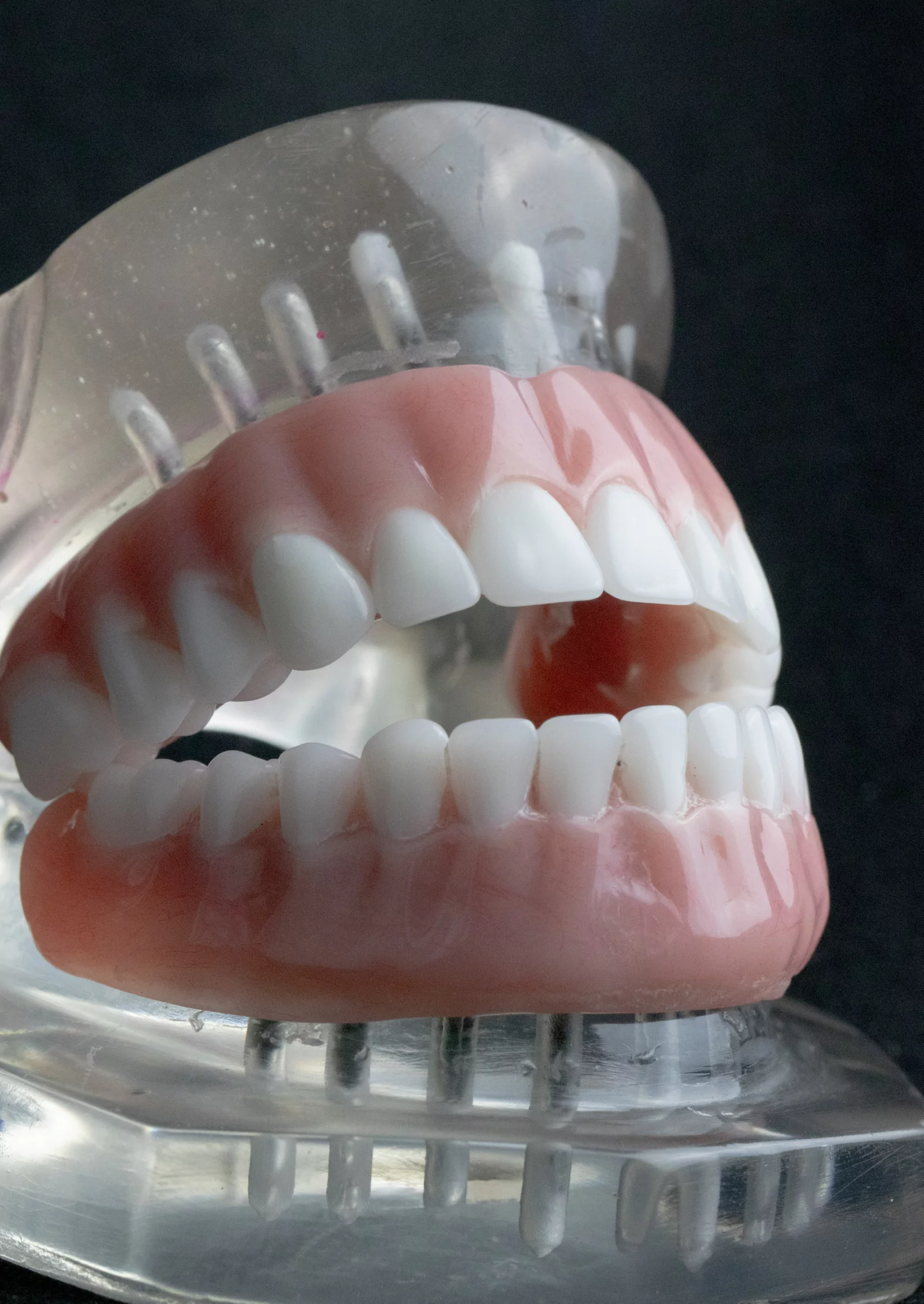 snap-in-dentures (38)