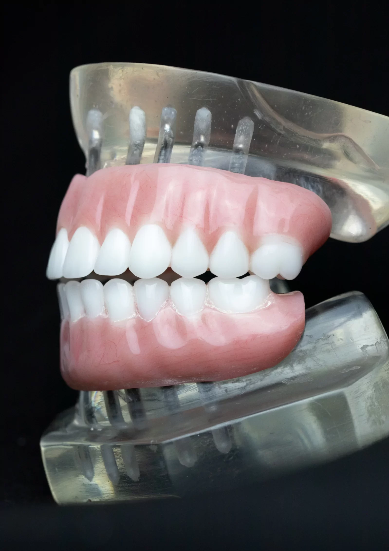 snap-in-dentures (41)