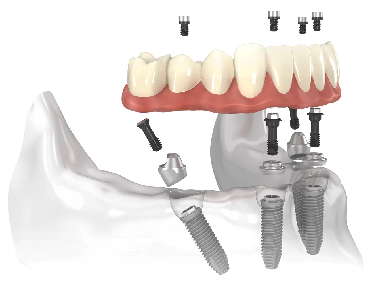 all-on-4-low-arch-white