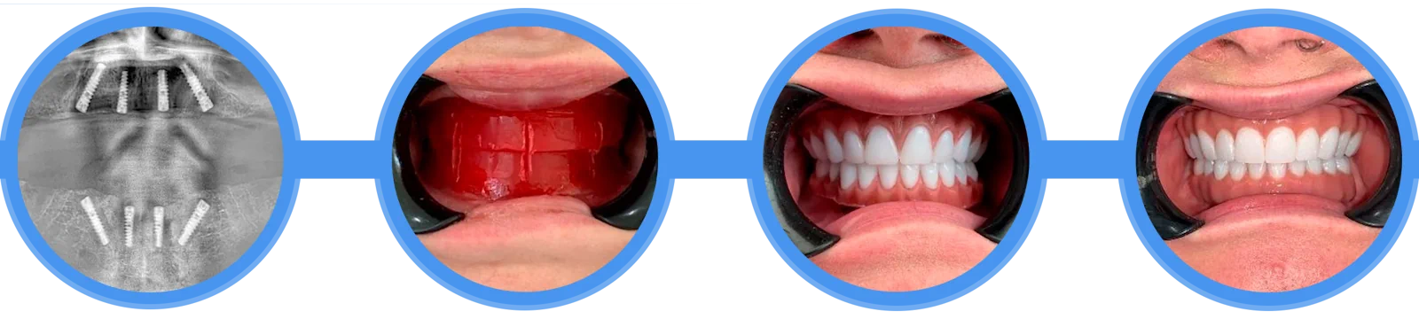 step-by-step-all-on-4