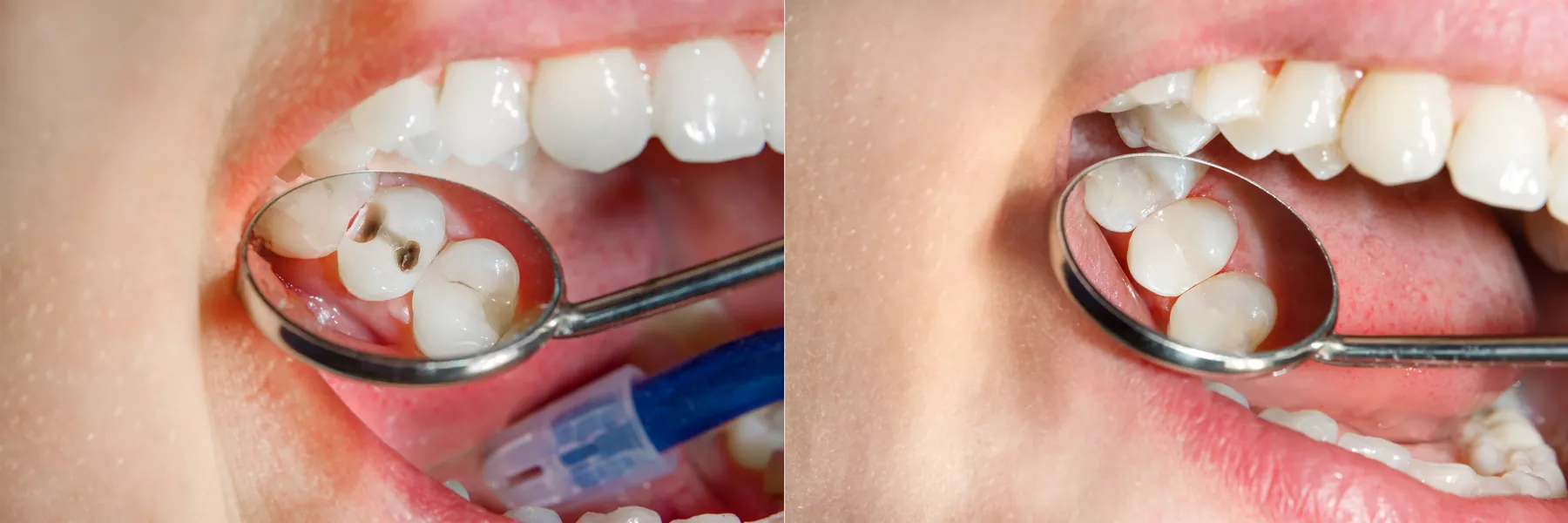 dental-fillings