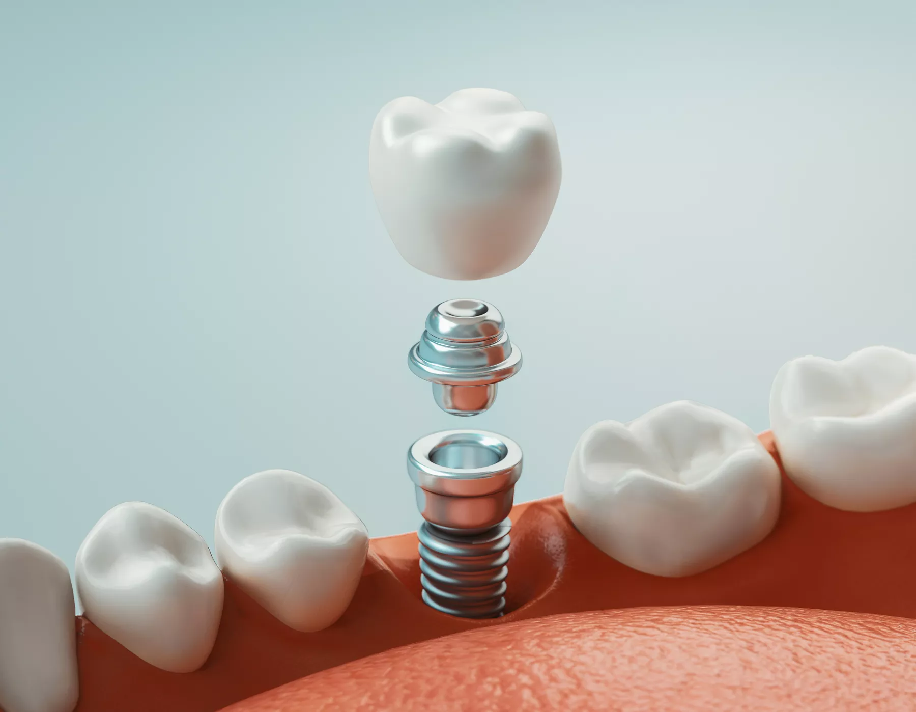 dental-implant