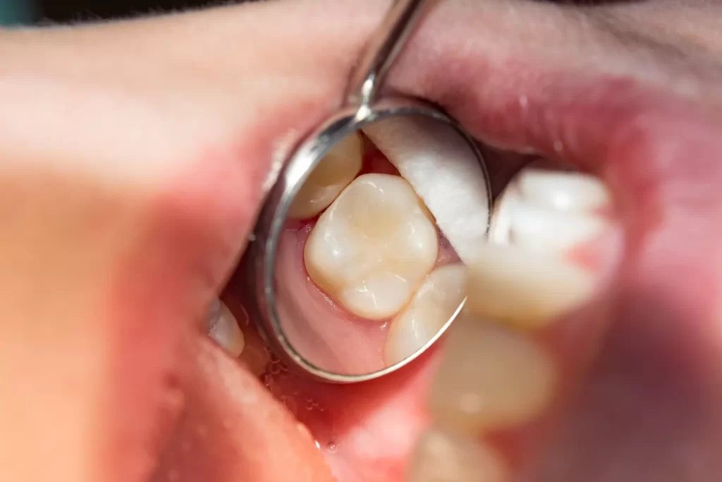 fillings